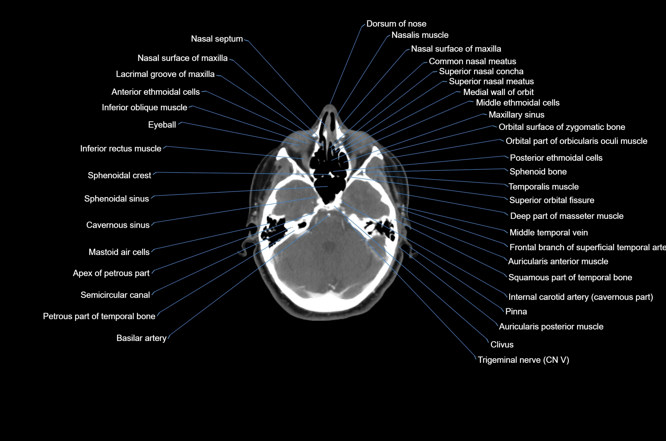 CT Neck axial cross sectional anatomy radiology image-img-00001-00010.webp